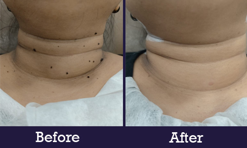 Before After neck 2