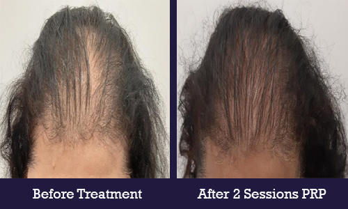 Before treatment After 2 Sessions PRP